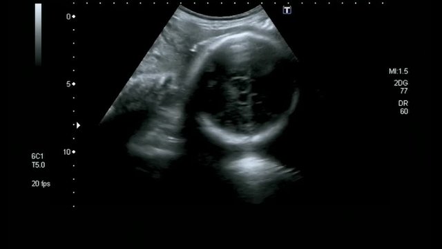 Ultrasound of seventh month baby in woman's womb