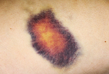 Bruise injury on woman thigh