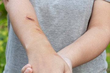 The wound form scabs on hand and arm. The wound happen during woman Injuries from falling down on road.