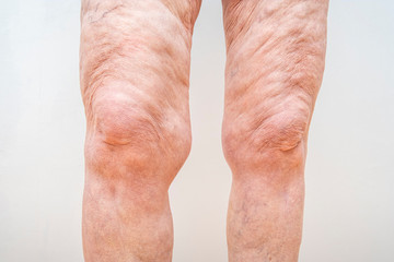 A lot of excess loose skin on legs of a senior woman after weight loss, gastric bypass surgery - obrazy, fototapety, plakaty