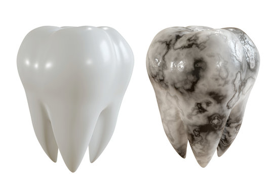 Comparison image of a healthy tooth and a caries patient. 3D Illustration.