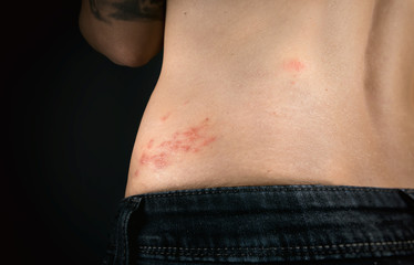Shingles outbreak on torso of woman. The varicella-zoster virus has formed a red rash with fluid-filled blisters on the lower back (shingles belt)