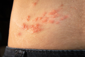 Shingles outbreak on torso. The varicella-zoster virus has formed a red rash with fluid-filled...
