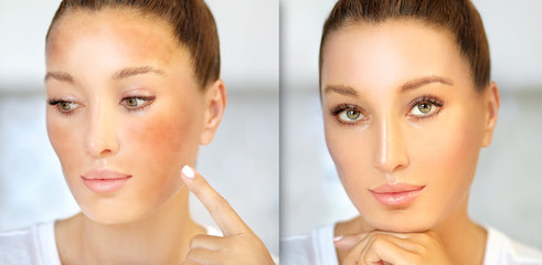 Dark spots, freckles,hyperpigmentation(melasma or chloasma)	