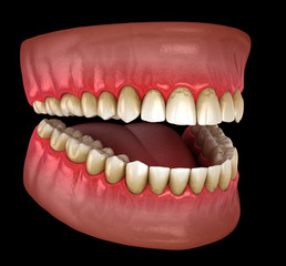 Tartar and bactrail tooth plaque, jaw inflammation. Medically accurate 3D illustration of human teeth treatment