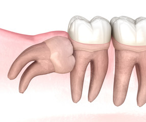 Horizontal impaction of Wisdom tooth. Medically accurate tooth 3D illustration
