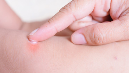 Kid have insect bites, mother applying antiallergic cream children knee