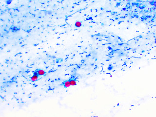 Cryptosporidium parvum protozoa positive (red sphere shape) in human stool smear, oocyst stage,...