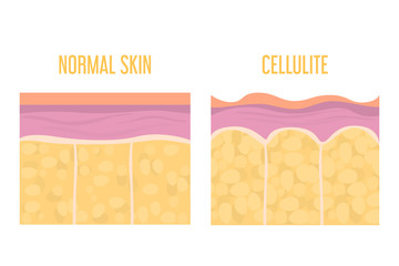 Cellulite skin and healthy skin anatomy. Fat tissue of human body - obrazy, fototapety, plakaty