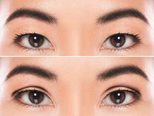 East Asian blepharoplasty or double eyelid surgery - obrazy, fototapety, plakaty