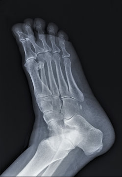 normal radiography of the foot, medical diagnostics, traumatology and orthopedics, rheumatology