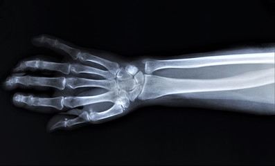 normal radiography of hand and wrist bones, traumatology and orthopedics, traumatology
