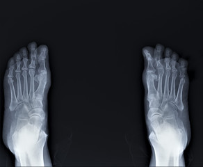 radiography of the foot by arthritis phenomena, medical diagnostics, Traumatology and orthopedics,...
