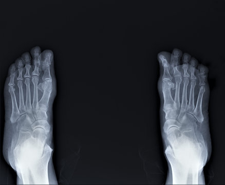 radiography of the foot by arthritis phenomena, medical diagnostics, Traumatology and orthopedics, rheumatology