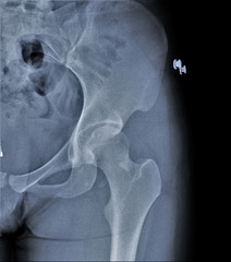 normal radiograph of the hip joint,coxarthrosis,medicine,diagnostic,ottopedia