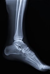 Naklejka premium normal radiography of the ankle joint in lateral projection, traumatology and orthopedics, rheumatology