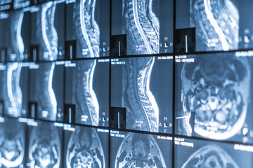 X-ray of the neck MRI. Vertebrae, osteochondrosis