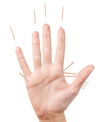 Female hand with inserted acupuncture needles.