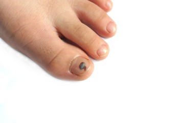 Foot problem - Black Toenail