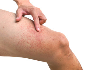 Red rash on leg isolated on white background / Rashes with virus