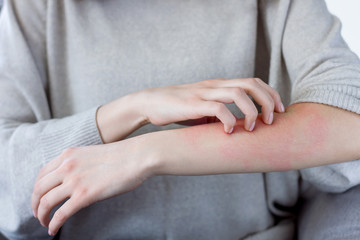 Closeup girl is scratching her hand with nails. Reddened, inflamed body parts causes discomfort and itching. Young woman is suffering from bouts of allergies. Dermatological skin diseases concept. - obrazy, fototapety, plakaty