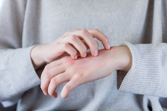 Closeup girl is scratching her hand with nails. Reddened, inflamed body parts causes discomfort and itching. Young woman is suffering from bouts of allergies. Dermatological skin diseases concept.