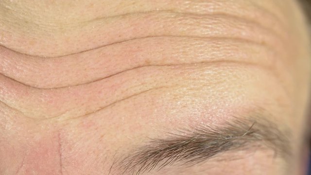 Facial wrinkles on the face of a person. Wrinkled forehead as a sign of surprise and bewilderment. A sign of age and aging close up. Manifestation of emotion.