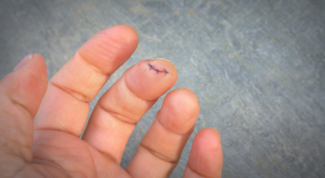 plaie suturée sur doigt de la main