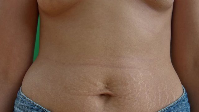 Caucausian woman with stretch marks on her belly, static shot of mid-section