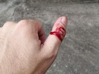 Fresh wound on the thumb finger  caused by knife.