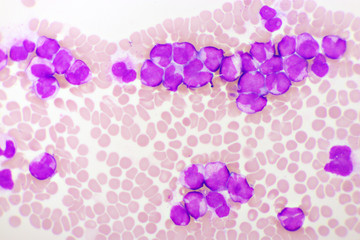 Fototapeta na wymiar Acute promyelocytic leukemia cells or APL, analyze by microscope, original magnification 1000x
