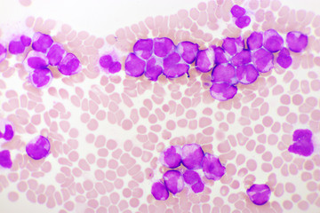 Naklejka premium Acute promyelocytic leukemia cells or APL, analyze by microscope, original magnification 1000x