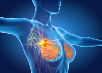 Breast cancer with lymphatics, medically 3D illustration