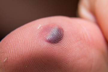 Blood blister under the thumb skin. Caucasian young man finger on white background.