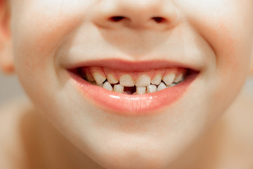 Obraz premium happy 6 year old boy shows teeth. loss of children's teeth.