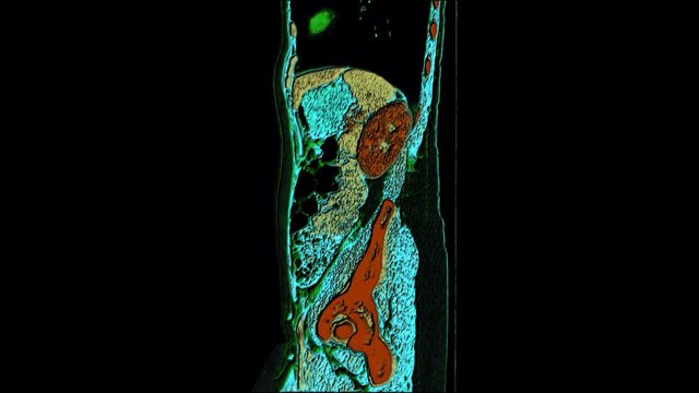 Color contrast MRI of the abdominal cavity, gastrointestinal tract, bladder