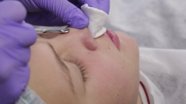beautician squeezing pimple blackheads for young wonan in beauty salon. facial skin care
