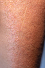 Naklejka premium Human skin with sunburn.