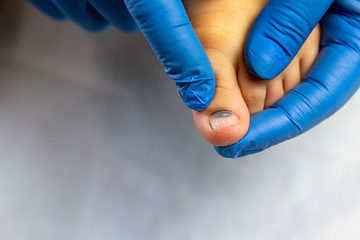 a doctor in a blue glove is examining a child s toe. close-up