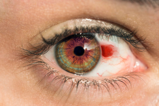 Hemorragia ocular en ojo verde