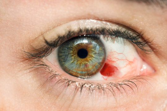 Hemorragia en ojo azul