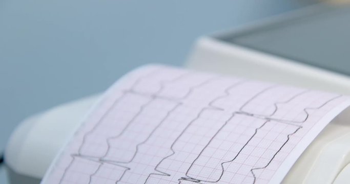 Close up graph printout from ecg machine during girl patient lying on bed. Electrocardiogram test.