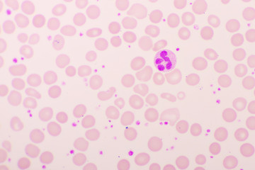 Essential thrombocytosis blood smear, present abnormal high platelet and neutrophil cell, analyze by microscope