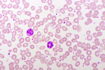 Essential thrombocytosis blood smear, present abnormal high platelet and neutrophil cell, analyze by microscope