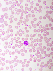Essential thrombocytosis blood smear, present abnormal high platelet and neutrophil cell, analyze...