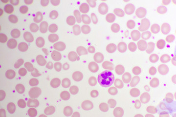 Essential thrombocytosis blood smear, present abnormal high platelet and neutrophil cell, analyze...