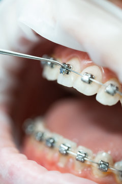 macro dentistry. Adjustment of braces on teeth with expander.