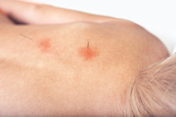 Fototapeta premium Woman on acupuncture