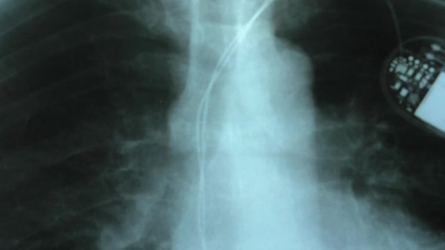 Doctor Examining X-Ray Image of Chest with Artificial Cardiac Pacemaker Implant