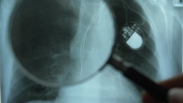 X-Ray Image of Chest with Artificial Cardiac Pacemaker Under Magnifying Glass